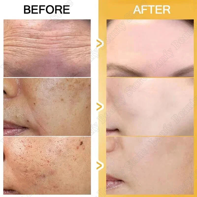 Freckle Whitening Cream Black Dots Melasma Remover Anti Brown Stain Lighten Pigmentation Moisturizing Skin Care Korean Products