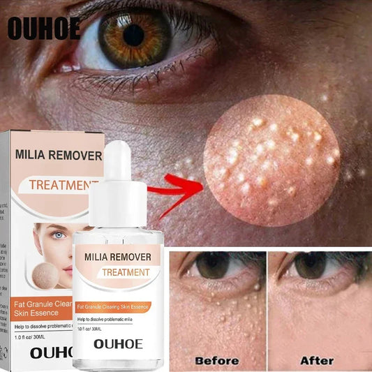 Fat Granules Removal Eye Serum Anti Dark Circle Eye Bags Fade Fine Line Essence Anti-puffiness Moisturizing Skin Care Products