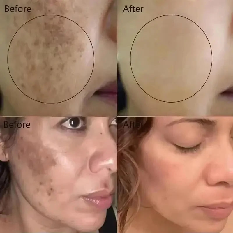 Freckle Whitening Cream Black Dots Melasma Remover Anti Brown Stain Lighten Pigmentation Moisturizing Skin Care Korean Products