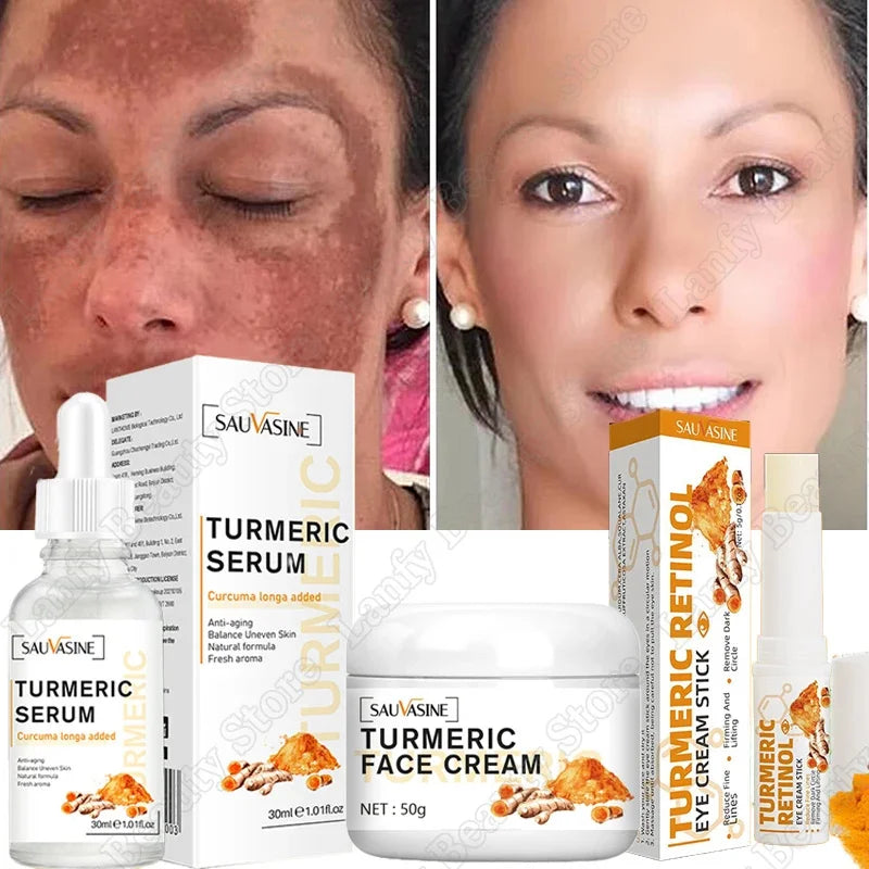 Freckle Whitening Cream Black Dots Melasma Remover Anti Brown Stain Lighten Pigmentation Moisturizing Skin Care Korean Products