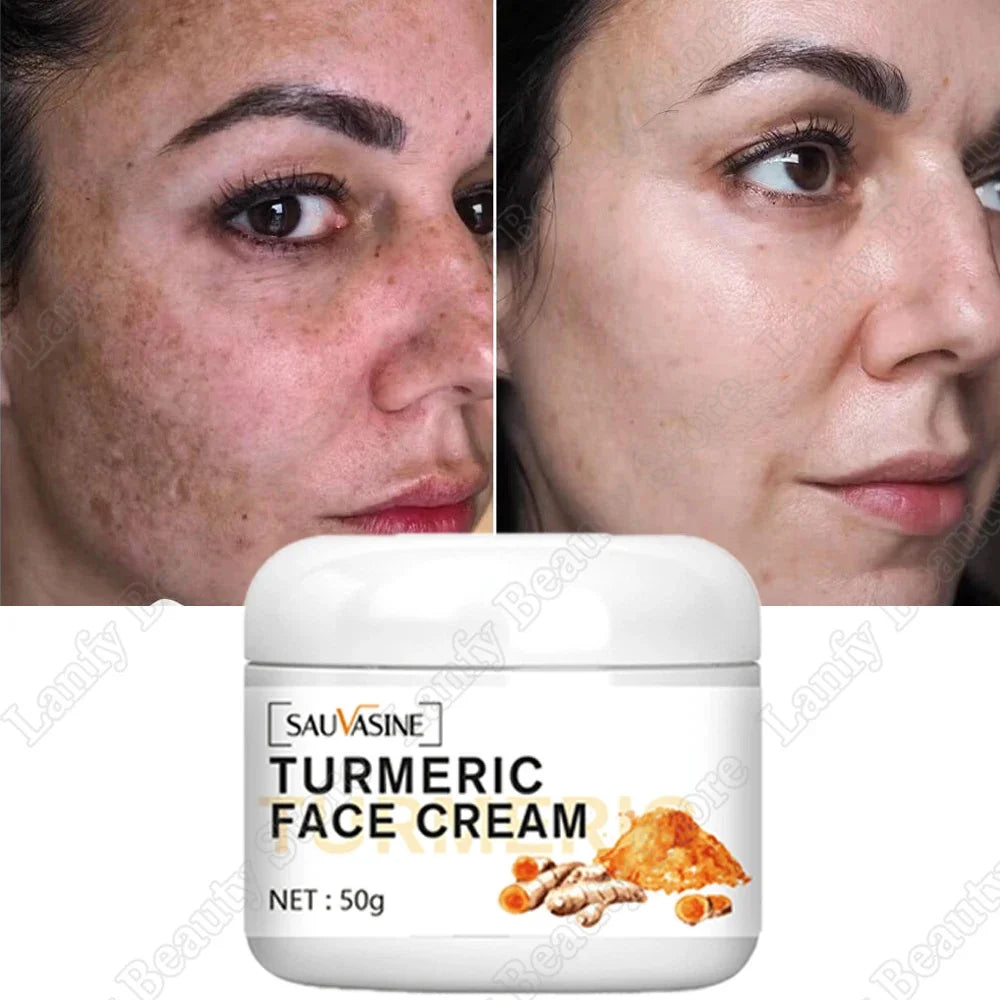 Freckle Whitening Cream Black Dots Melasma Remover Anti Brown Stain Lighten Pigmentation Moisturizing Skin Care Korean Products