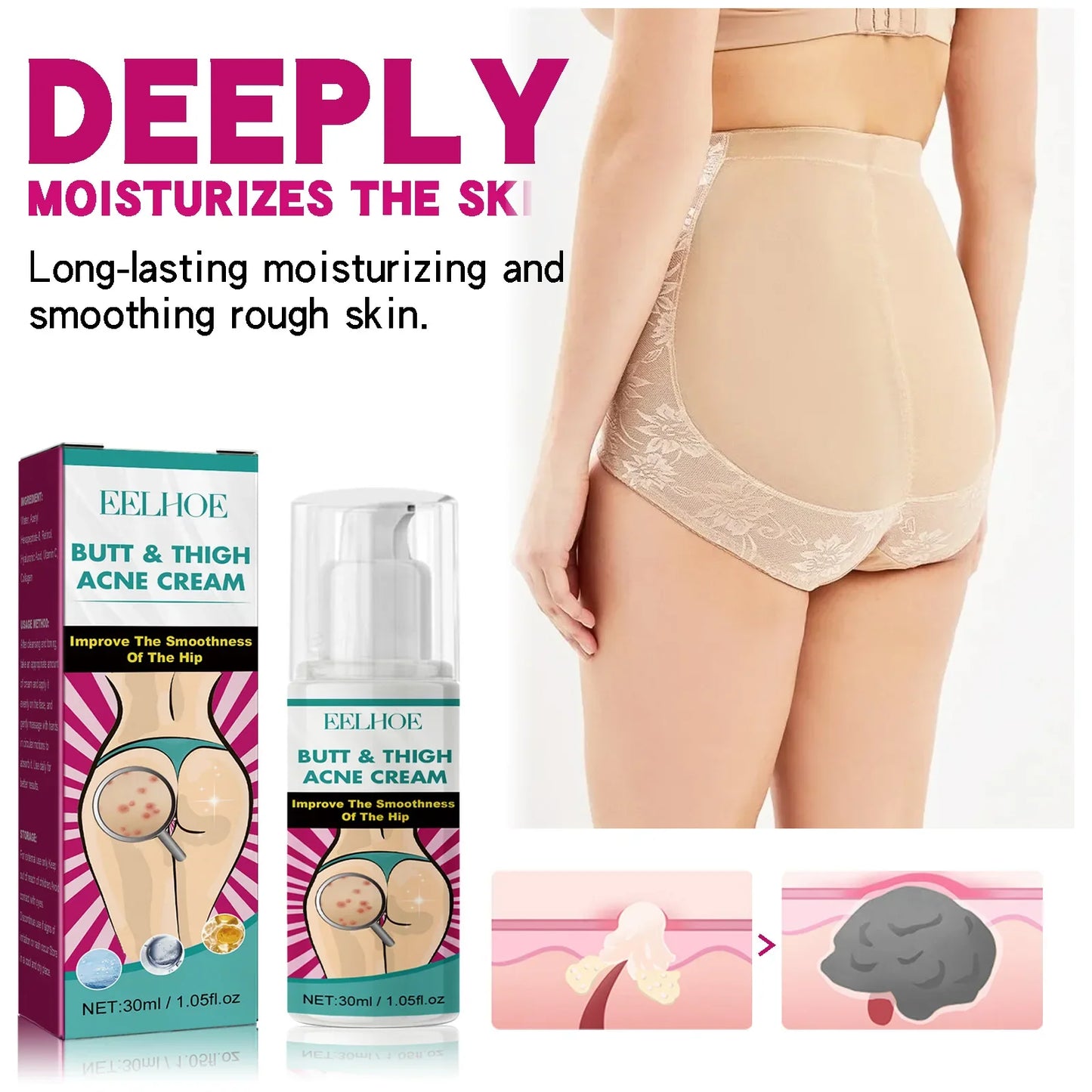 Butt Thigh Acne Clearing Cream Zits Razor Bumps Spot Treatment Preventing Sexy Hip Sagging Lift Whitening Buttocks Pimples Cream